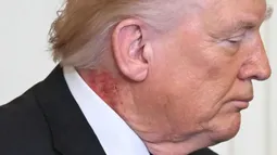Donald Trump y la mancha roja en su cuello: Qué explicó su médico sobre su estado de salud