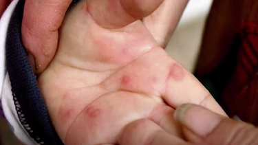 La propagación de la fiebre del tomate en la India provoca nueva alerta