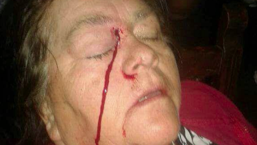 INDH se querellará contra Carabineros por mujer que perdió ojo por perdigón en medio de protestas en Villarrica