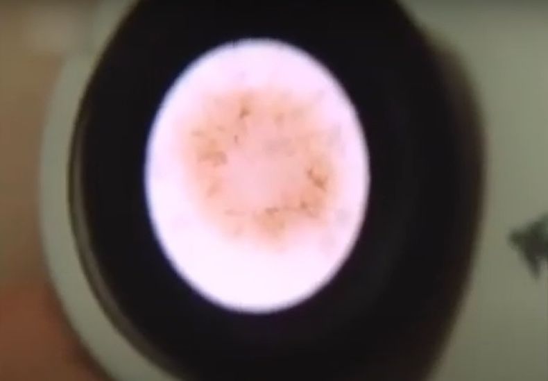 Melanoma.jpg