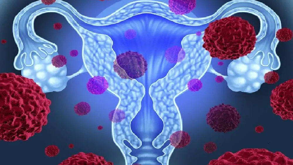 Cáncer cervicouterino: Cuál es la edad sugerida para tomarse exámenes y cómo prevenir el VPH