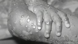 EMA respalda uso intradérmico de la vacuna Imvanex contra la viruela del mono