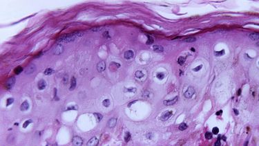 Expertos plantean hipótesis de que la viruela del mono se transmita sexualmente