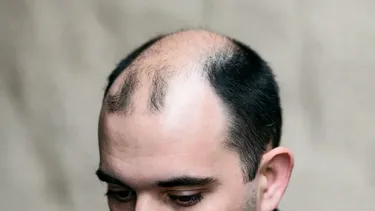 Implante capilar se adelanta en Chile: 24% de los pacientes tiene entre 21 y 35 años y crece consulta por alopecia masculina