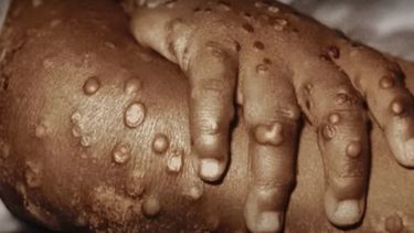 Nuevo método de vacunación quintuplicará dosis contra la viruela de mono en EE.UU.