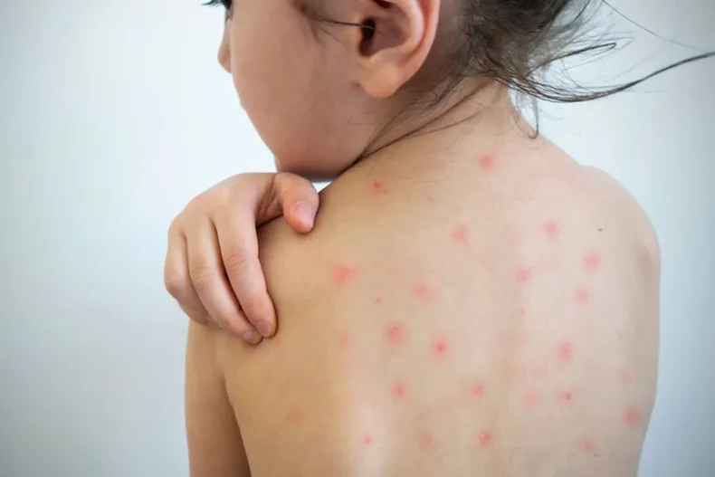 26729 measles su19.webp