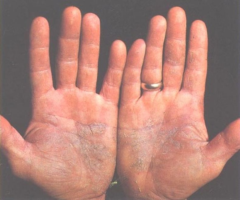 Psoriasis_of_the_palms.jpg