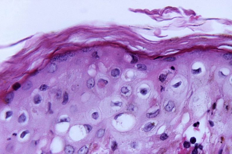 Viruela del mono scaled.jpg