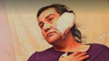 Denuncian grave ataque con machete a mujer trans en San Carlos: Fue herida en el rostro, cabeza y oreja