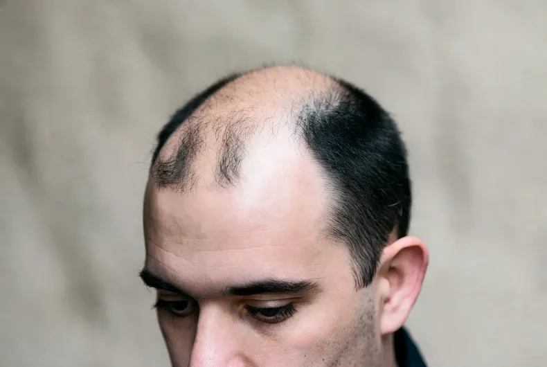 implante capilar se adelanta en chile 24 de los pacientes tiene entre 21 y 35 anos y crece consulta por alopecia masculina.webp