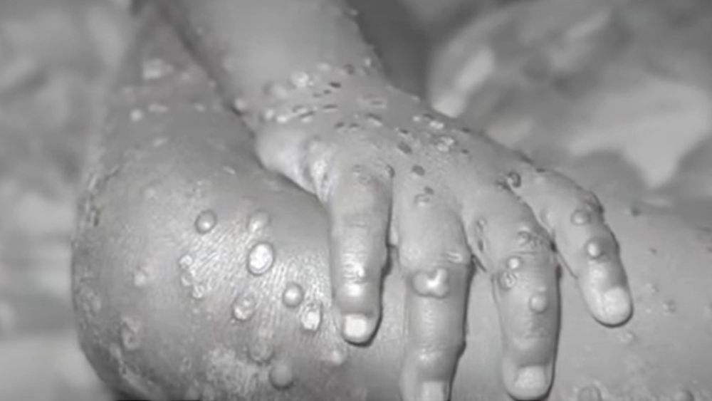 “No está de más repensar el uso de mascarillas: Experta y llegada de la viruela del mono a Chile