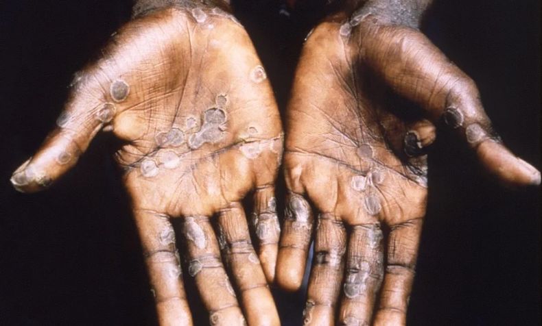 viruela del mono.jpg