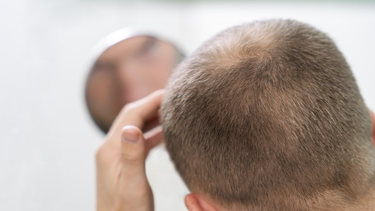 Alopecia masculina.