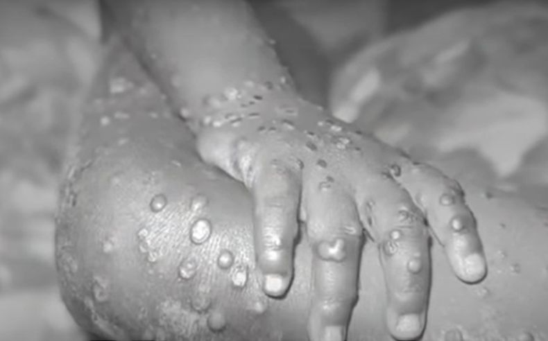 3893 viruela foto.jpg