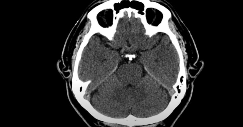 Cerebro.jpg