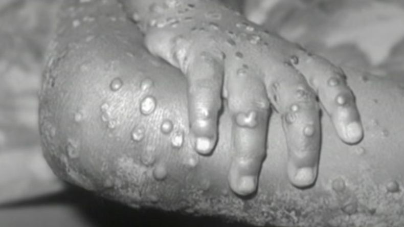 viruela del mono DW ota.jpg