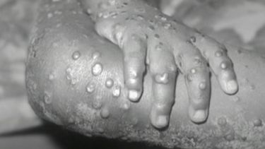 Confirman la primera muerte por viruela del mono en Brasil