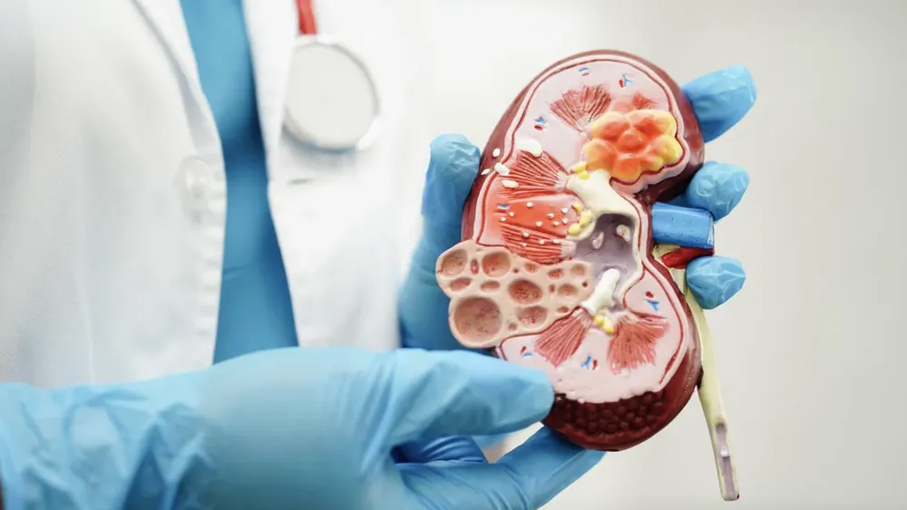 Cáncer de riñón en aumento: A qué edad se desarrolla y cuáles son los 6 síntomas que no debes ignorar