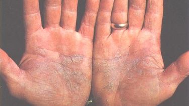 El Desconcierto | Psoriasis_of_the_palms.jpg