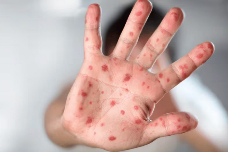 fiebre repentina, dolores y erupcion cutanea los 3 sintomas para identificar viruela del mono.png