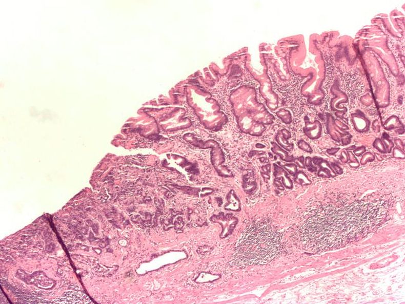 640px Gastric_adenocarcinoma.jpg