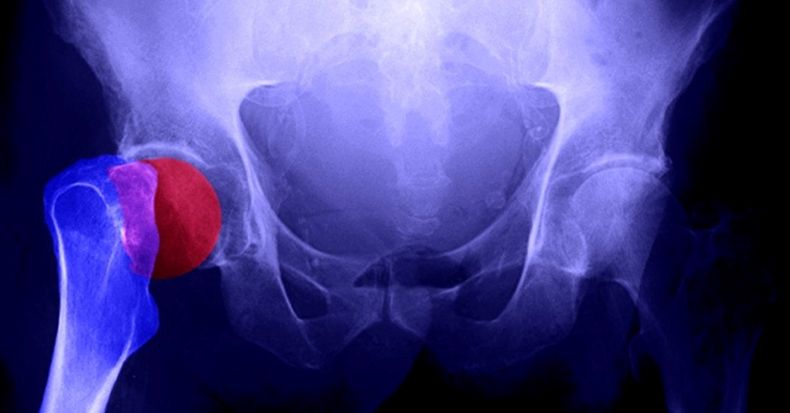 Osteoporosis referencial.jpg