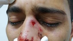 Agresión homofóbica: Joven técnico en enfermería fue atacado con botellas en Viña del Mar