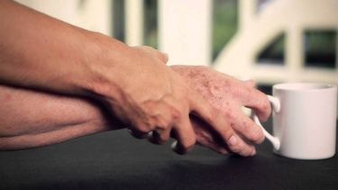 Estimulación Cerebral Profunda: La terapia que permite volver a disfrutar la vida a enfermos de Parkinson