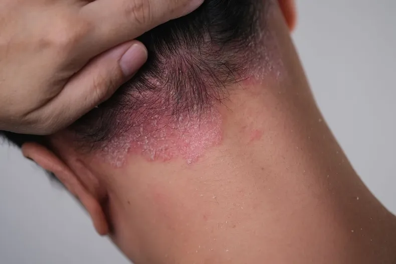 25009 psoriasis 1.webp