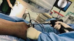 Médicos chilenos desarrollan novedosa técnica que evita infecciones en paciente con fracturas