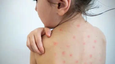 Crisis de salud pública en Argentina: la vacunación infantil contra sarampión y coqueluche cae al 50%