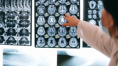 Cáncer en Chile: incidencia, mortalidad y prevención de los cinco tipos más comunes según el informe GLOBOCAN 2022