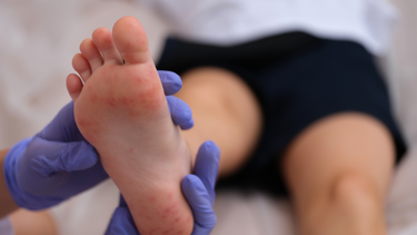 Fiebre y ampollas: Advierten incremento de contagios en niños y niñas por virus boca-mano-pie