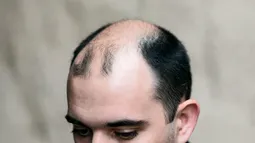 Implante capilar se adelanta en Chile: 24% de los pacientes tiene entre 21 y 35 años y crece consulta por alopecia masculina