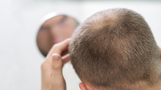 Alopecia masculina. Alopecia masculina.