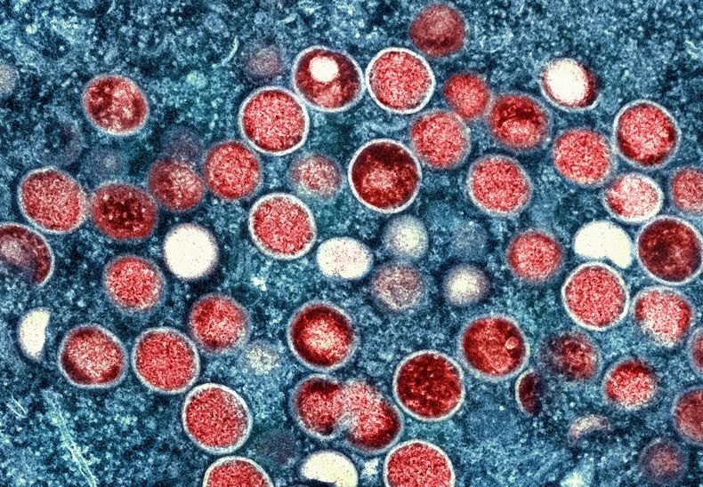 Viruela del mono 4.jpg