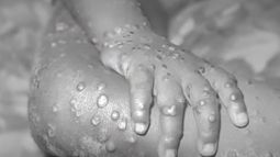 Exseremi de Salud: La combinación viruela del mono y Fiestas Patrias es un tema complejo