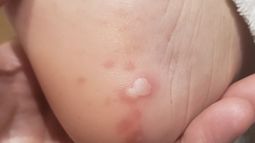 Identifican cinco lesiones cutáneas asociadas al coronavirus